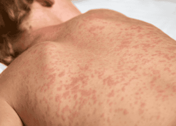 Estado sem sarampo há 24 anos