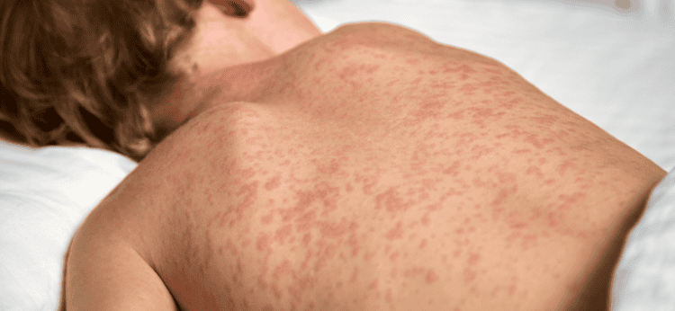 Estado sem sarampo há 24 anos